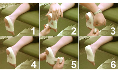 plantar fasciitis taping treatment