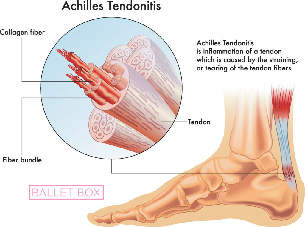 Achilles tendonitis balletbox