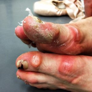 ballet dancer feet beat up