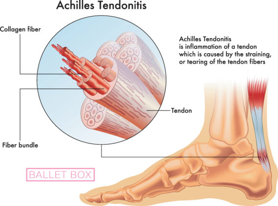 Ballet Dancer Achilles Tendonitis 5347